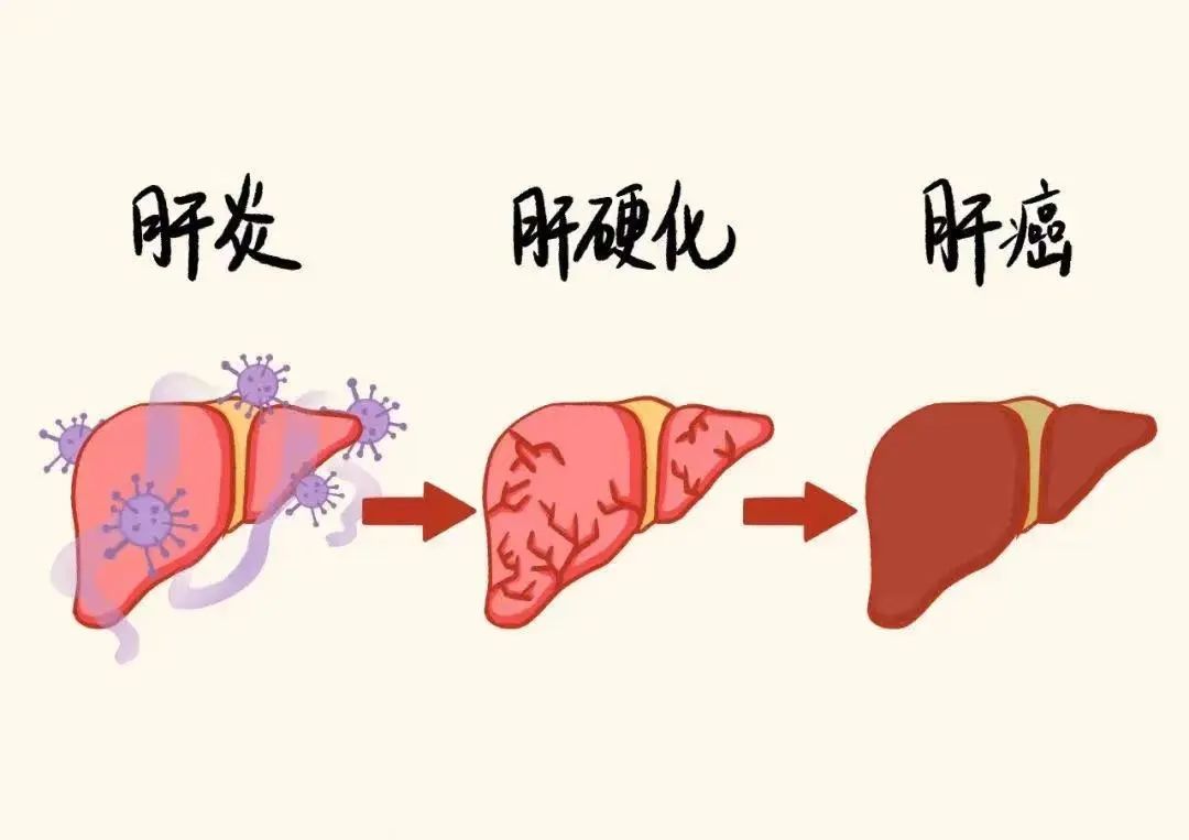 肝癌一经发现就是中晚期？这样体检可将早期检出率提高到八成以上
